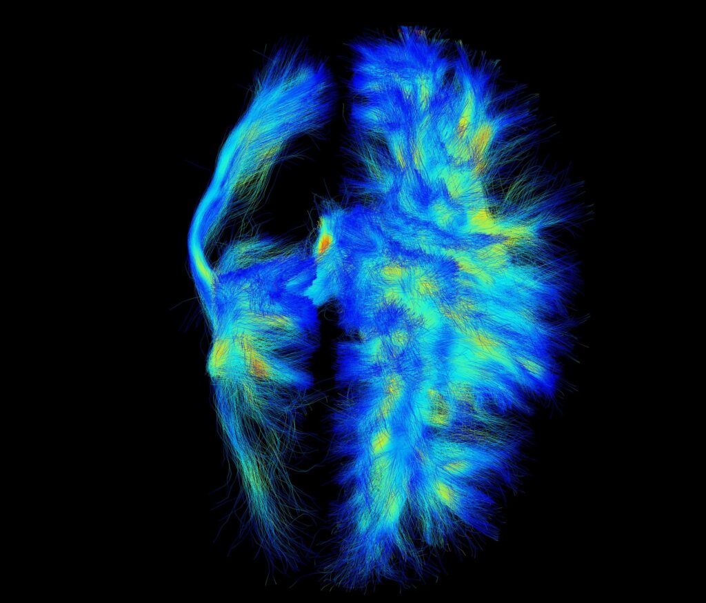 Les réseaux neuronaux de notre cerveau s’apparentent à des autoroutes (jaune-orange) ou à des routes secondaires (bleu). Ici, vus du dessus par neuro-imagerie, les deux hémisphères du cerveau d’un enfant de 9 ans. Leur asymétrie est frappante. Elle témoigne de lésions survenues lors du développement du fœtus, d’où une paralysie cérébrale. Et, visiblement, l’hémisphère gauche contient beaucoup moins de routes. Cela se traduit entre autres par des problèmes moteurs. Déchiffrer la carte routière neuronale chez les enfants atteints est crucial afin de mieux comprendre leurs symptômes et d’améliorer les interventions, qui, à ce jour, n’ont qu’une efficacité modérée.
